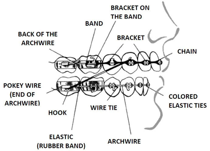 wire-poke - Forbes Orthodontics