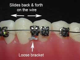 Poking Wire? Here are Some Pointers - Orthodontist Newark Middletown DE  Invisalign Braces Honig Orthodontics