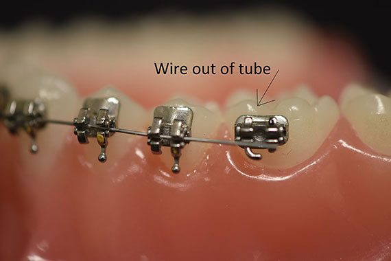 The wire for my braces has come off the bracket, but it's still attached.  Should I get it fixed? - Quora