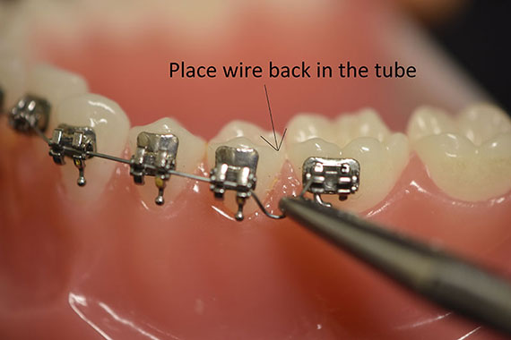 Pokey Braces Wire Causing You Pain? Here's How to Fix It in a