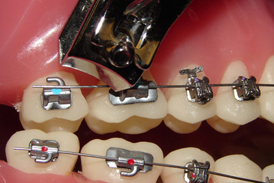 What To Do If You Have A Sharp Braces Wire - Ethos Orthodontics