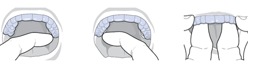 Invisalign and Clear Retainer